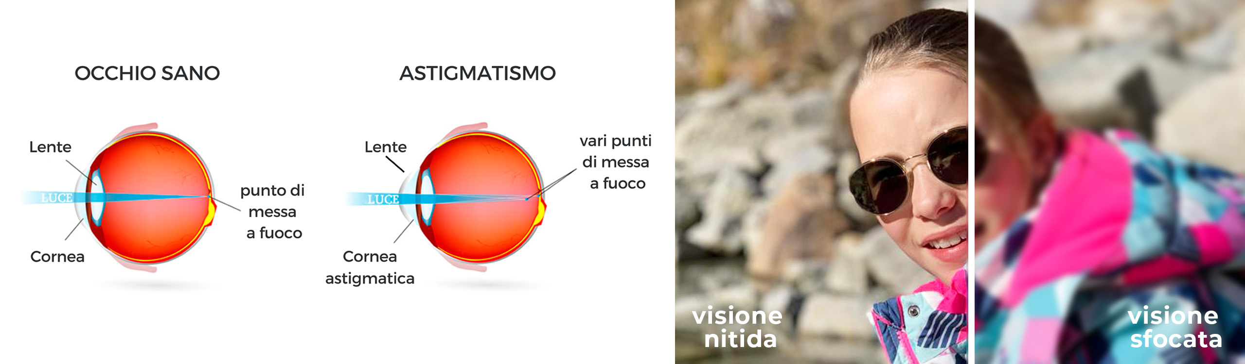 Differenze tra occhio sano e affetto da astigmatismo. 